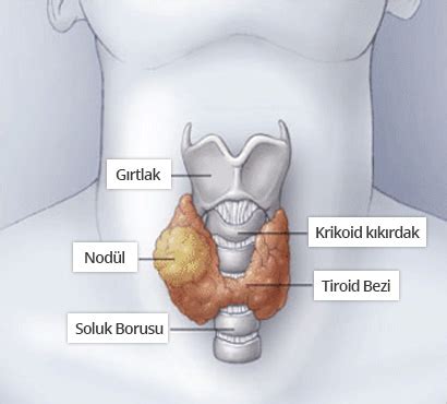 tiroid hipodens nodül nedir